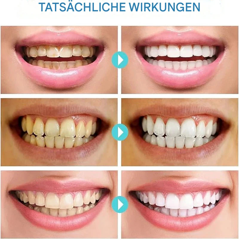PureTeeth™ - Sofortige Aufhellung