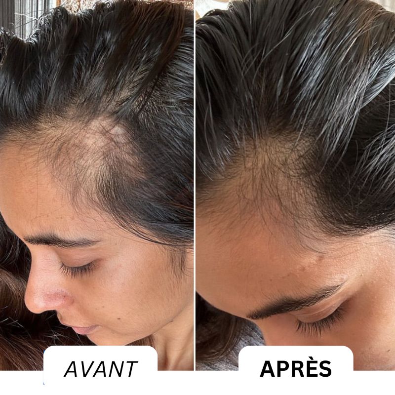 Scalpy™ | Kopfhautmassagegerät mit Infrarotlicht