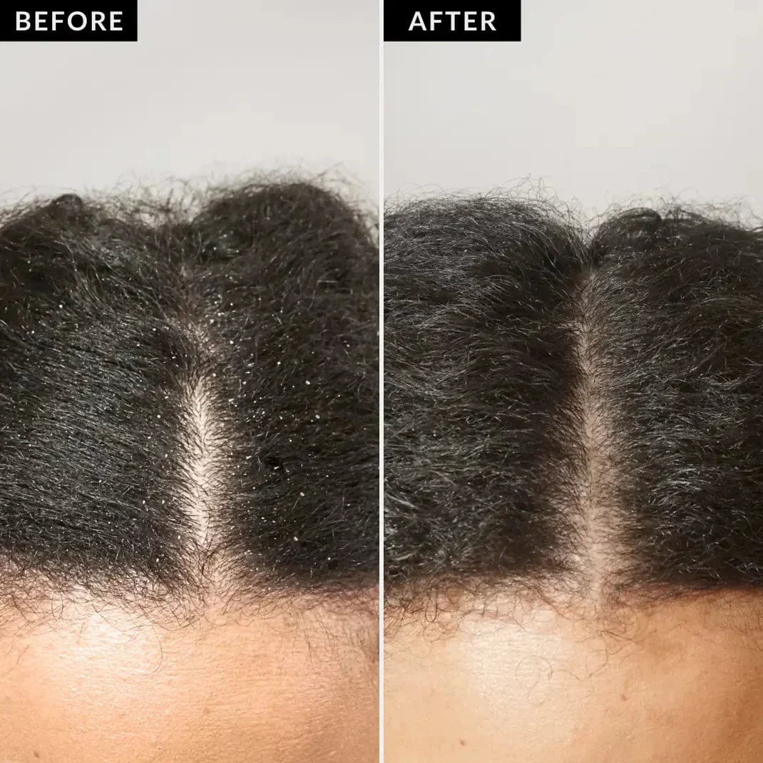 MassageComb™ | Tragbarer Energiekamm zur Juckreizlinderung und Ölkontrolle (1+1 GRATIS)