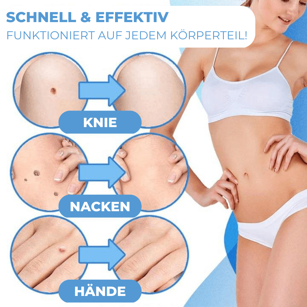 Warzen & Muttermale Entferner Set | Schmerzfrei | Schnelle Ergebnisse | Für alle Hauttypen