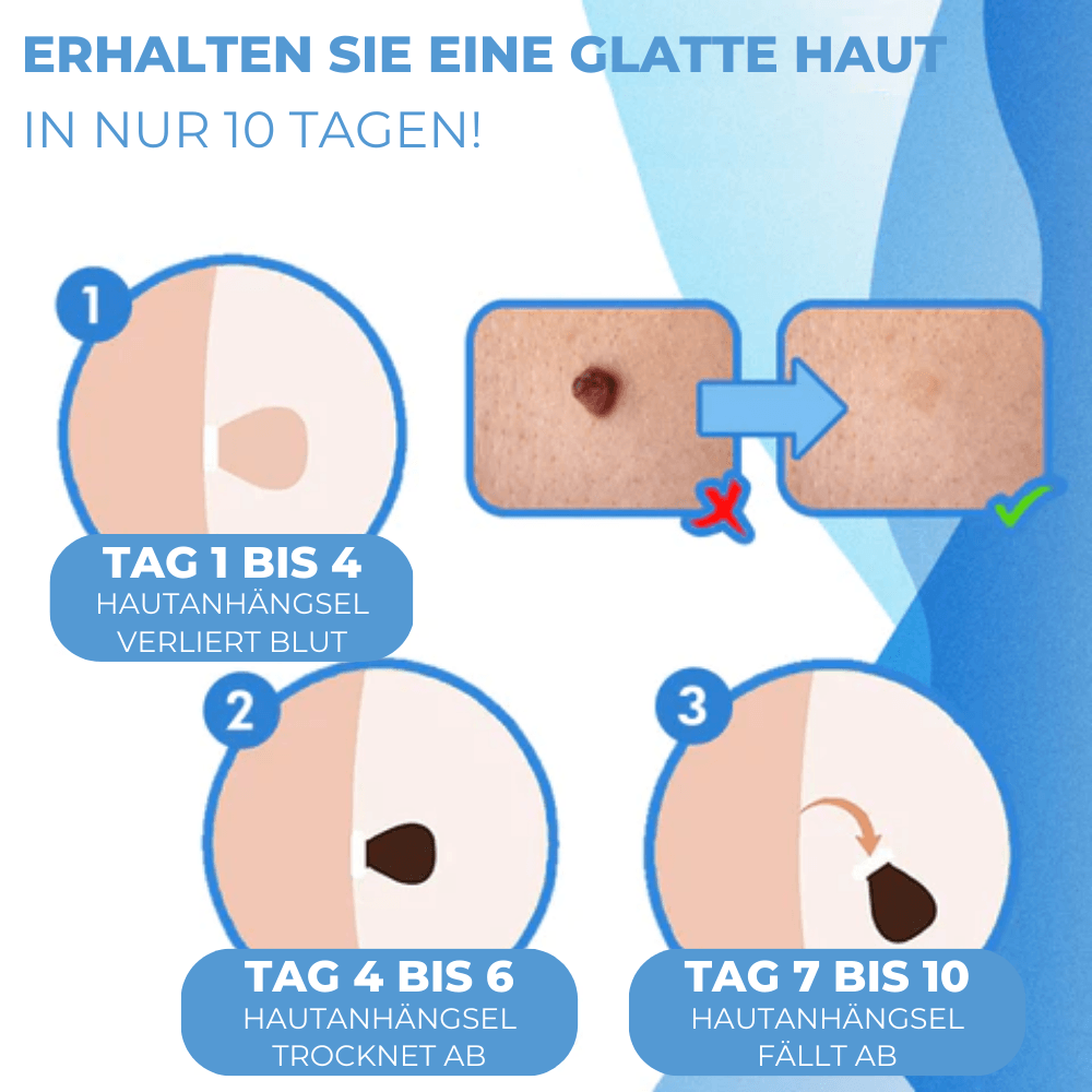 Warzen & Muttermale Entferner Set | Schmerzfrei | Schnelle Ergebnisse | Für alle Hauttypen