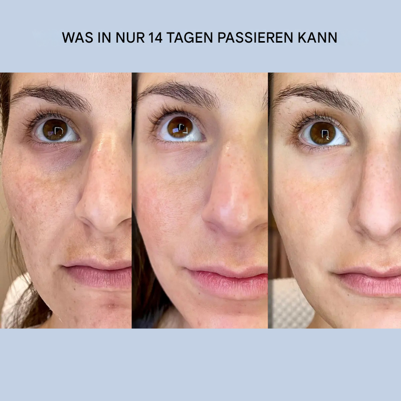 1+1 Gratis | YouthLift Renew Streifen™ Glätten, Straffen und Revitalisieren Sie sofort die natürliche Ausstrahlung Ihrer Haut