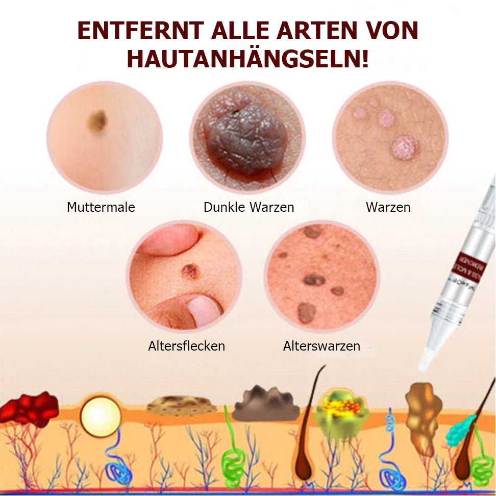 1+1 Gratis | SkinFix™ - Hautmakel und Muttermal Entferner