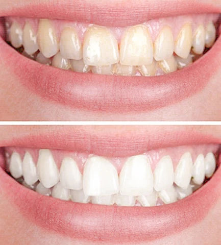1+1 Gratis | Dental White™ - Zahnaufhellungsstift