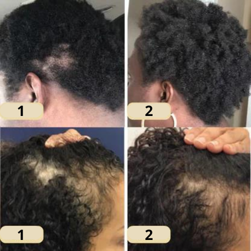 HairGrow™ - Vogany Natürliches Haarwuchsöl (50% RABATT)