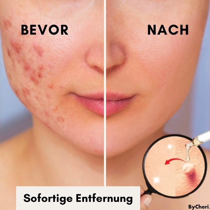 FlawlessFade™ | Verabschieden Sie sich von Hautunreinheiten