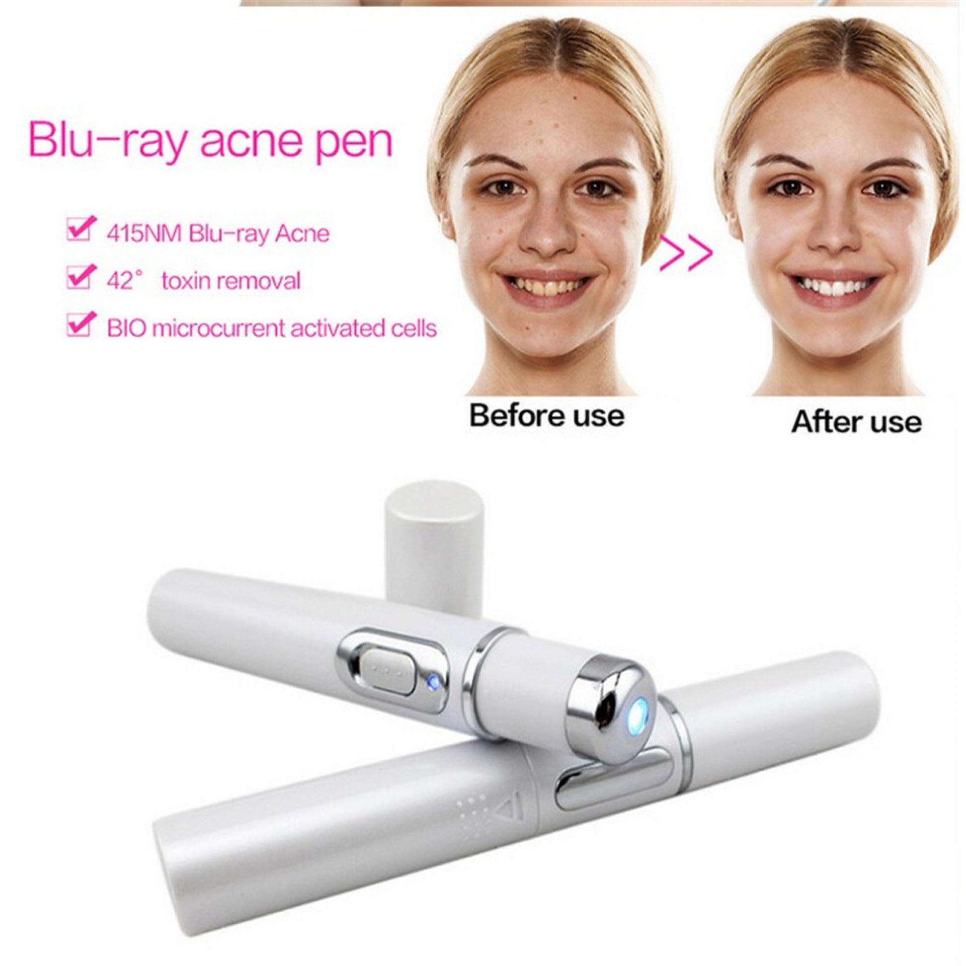 Laser Therapy Aknegerät | Blaulichttherapie | Tragbar & Chemiefrei | 4-in-1 Hautpflege