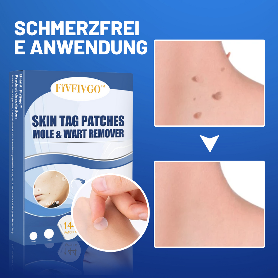 TagAway™ - Schmerzfreie, nicht-invasive Behandlung