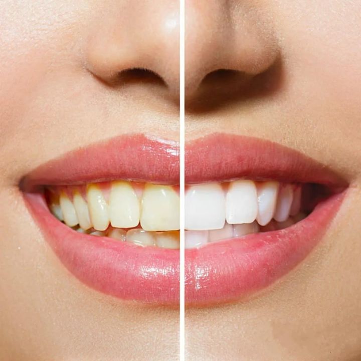 SmileSonic™ - Professionelle Zahnpflege jetzt zu Hause
