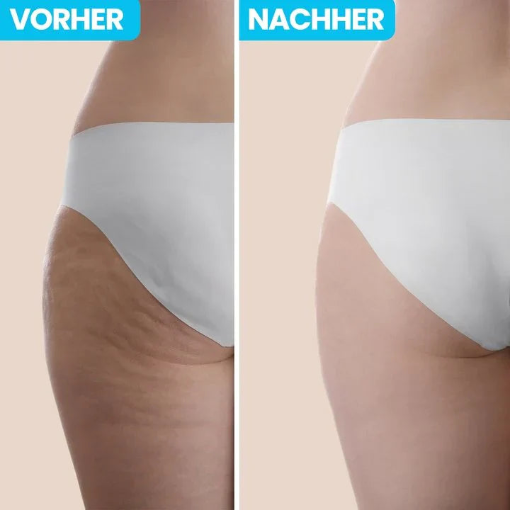 Smoothify™ - Entfernen Sie Cellulite bequem von zu Hause aus!