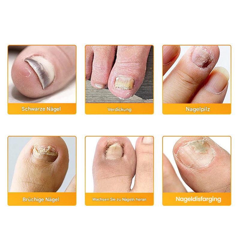 1+1 GRATIS | Nailox™ – Schnelle & diskrete Nagelpilz-Behandlung