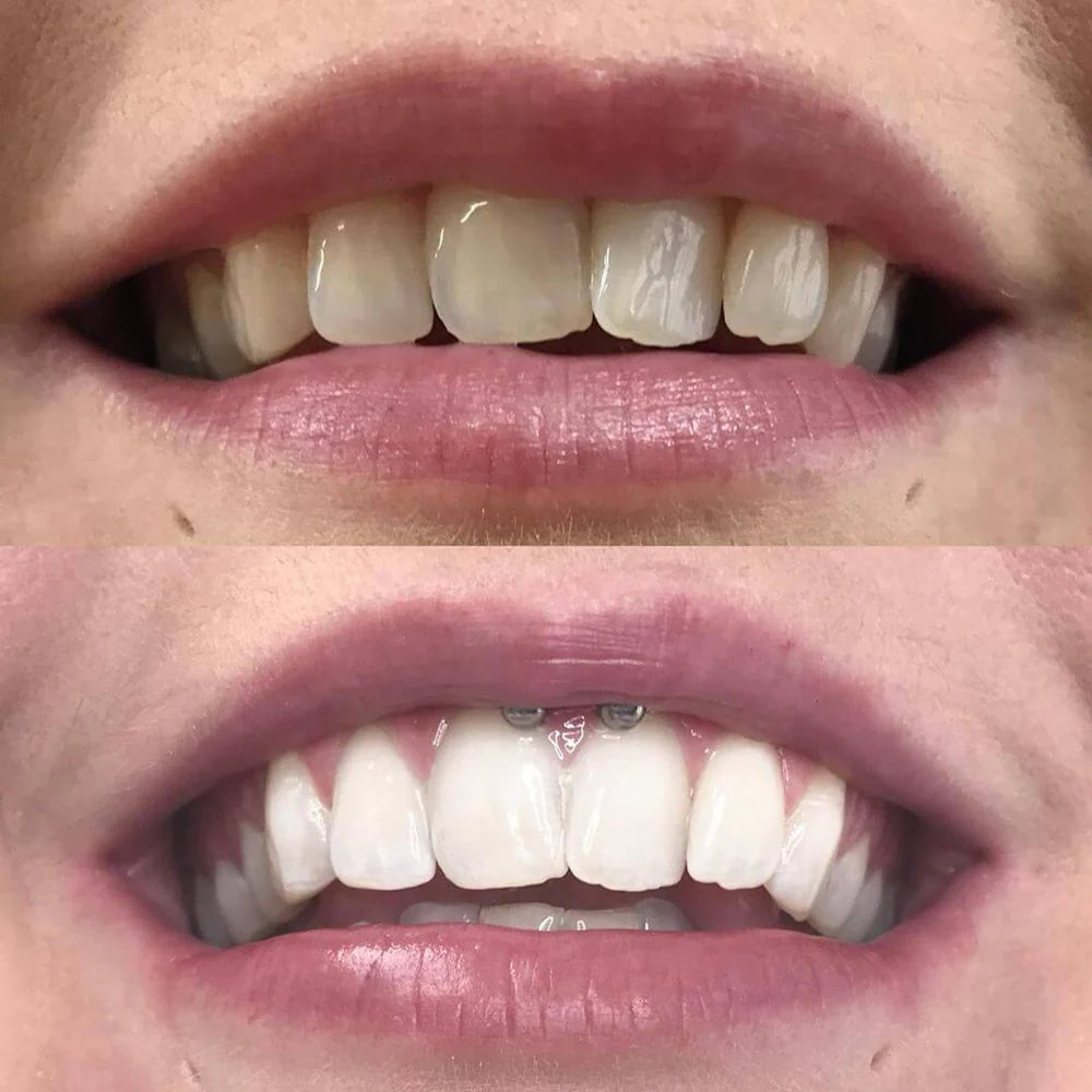 1+1 Gratis | Diamond Smile™ — Entfache Dein Strahlen und strahle mit Selbstvertrauen