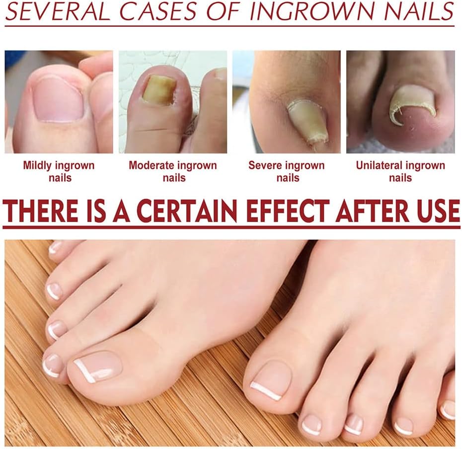 1+1 Gratis | HealNail™ Reparatur beschädigter Nägel in 4 Wochen