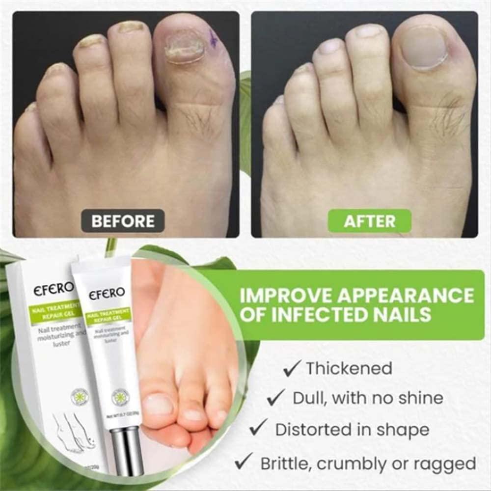 1+1 GRATIS | RejuveNail™ - Steigert die Kraft für gesunde, schöne Nägel!