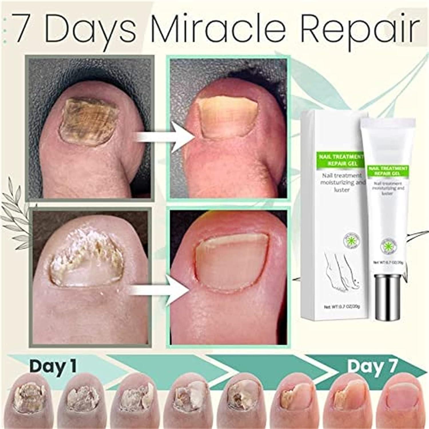 1+1 GRATIS | RejuveNail™ - Steigert die Kraft für gesunde, schöne Nägel!