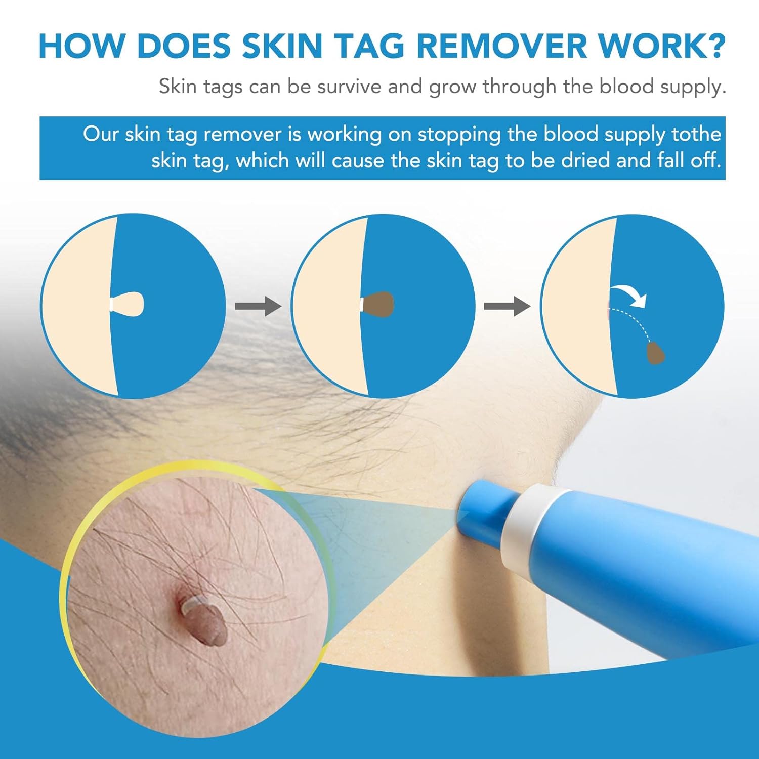 FlawFix™ | Stielwarzen Entfernungsset