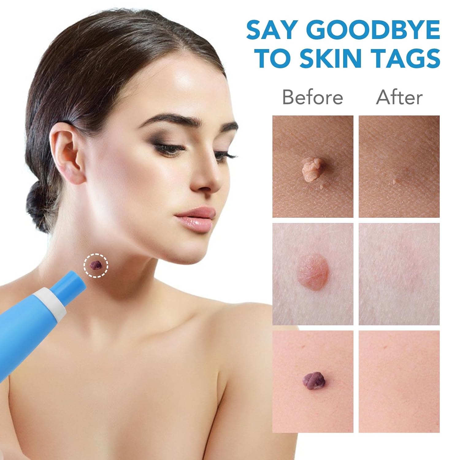 FlawFix™ | Stielwarzen Entfernungsset
