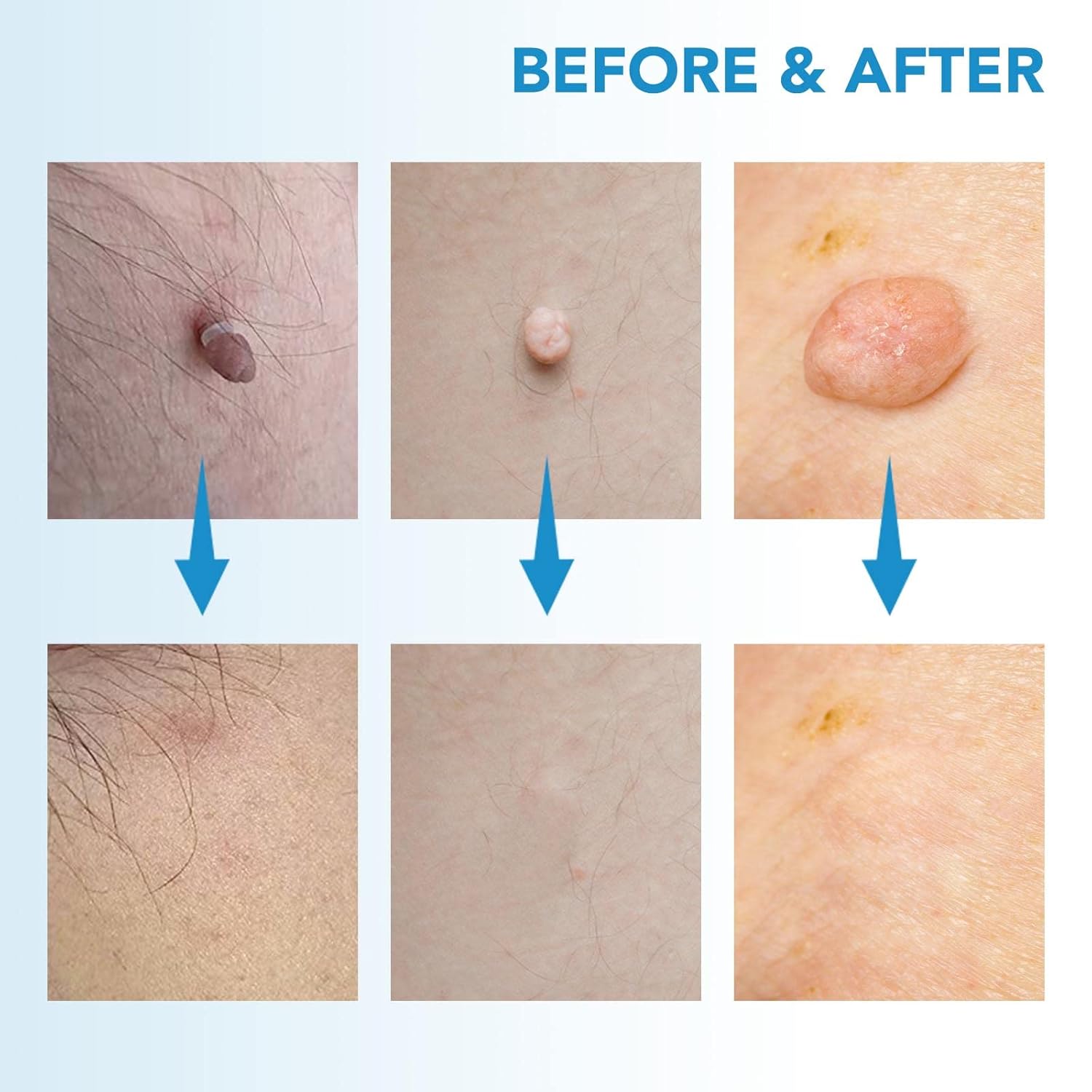 FlawFix™ | Stielwarzen Entfernungsset