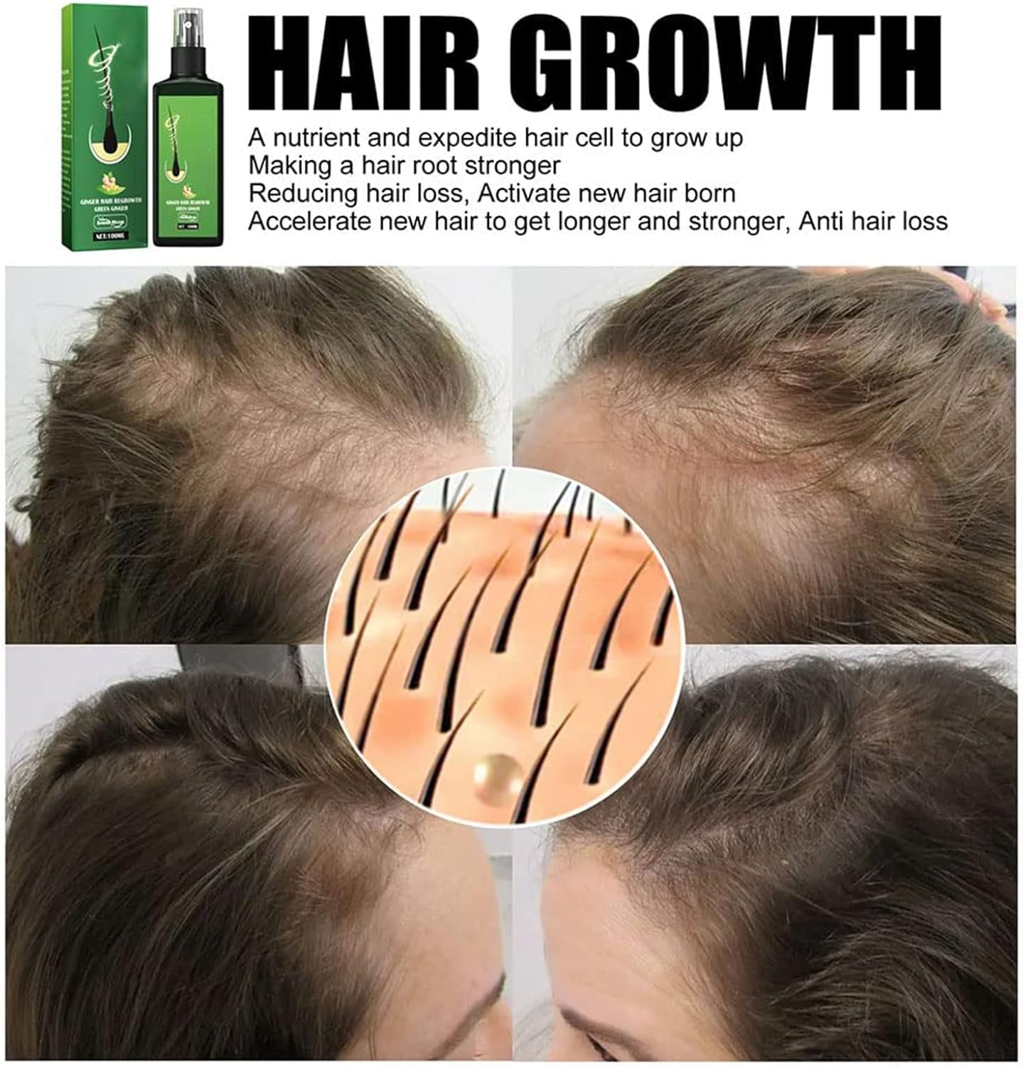 GingerGlow™ Haarwuchsspray | Ingwer & Minoxidil | Gegen Haarausfall