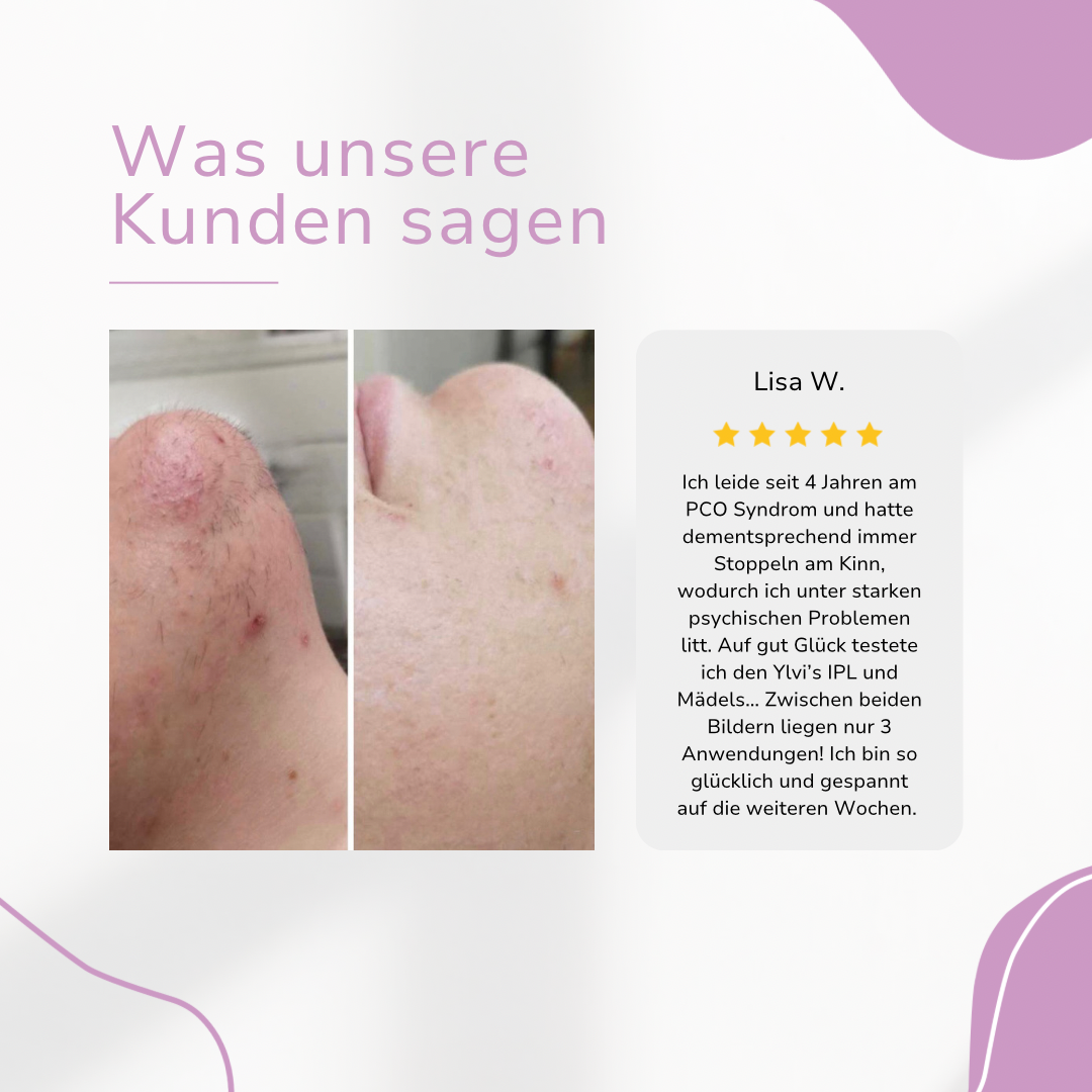 Ylvis IPL Hair Remover I Die führende Laser-Haarentfernung für Zuhause