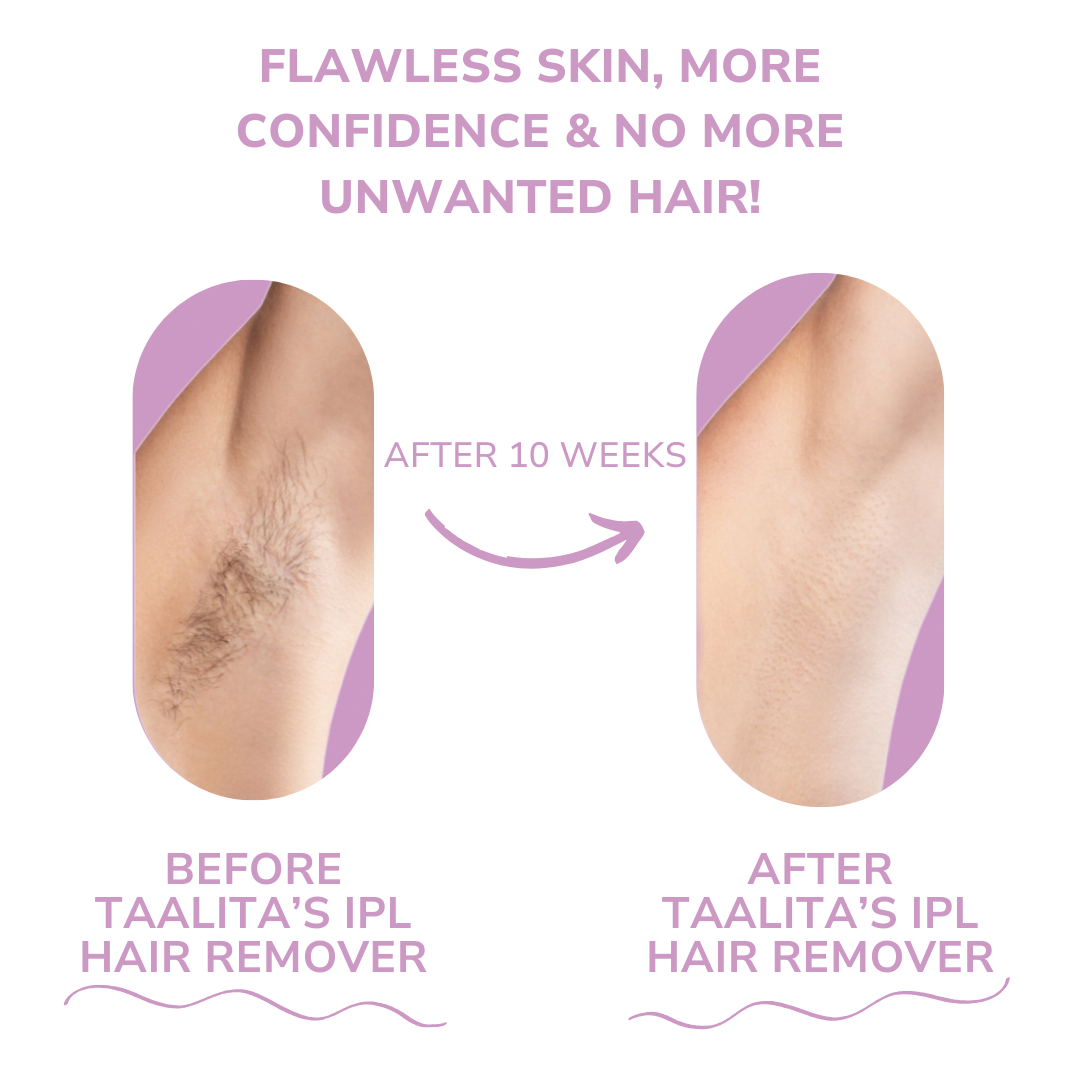LumaSilk™ – Hartnäckige Haare sanft und effektiv zu Hause entfernen