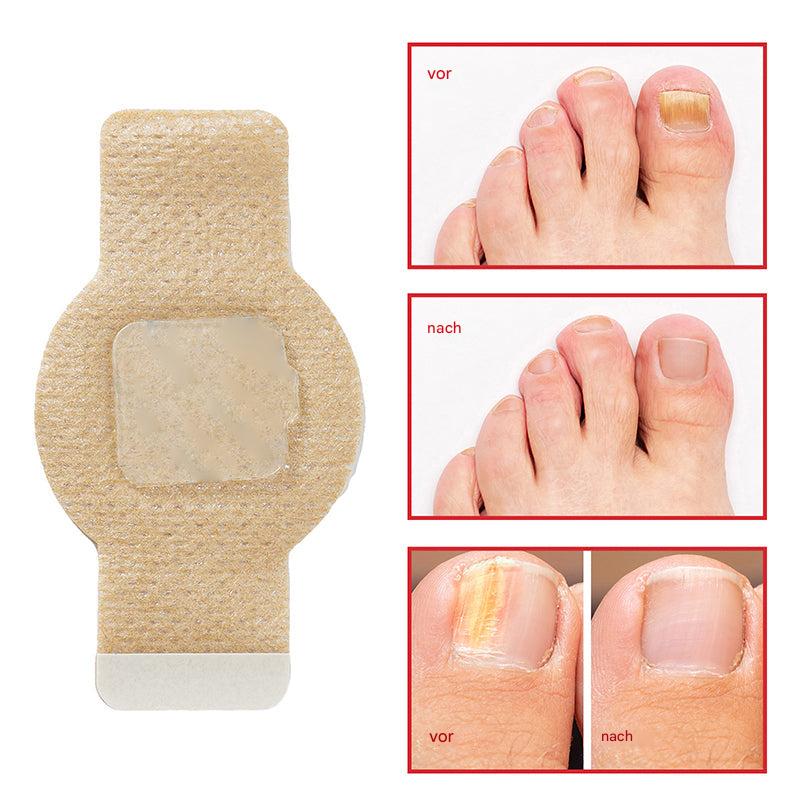 1+1 GRATIS | Nailox™ – Schnelle & diskrete Nagelpilz-Behandlung