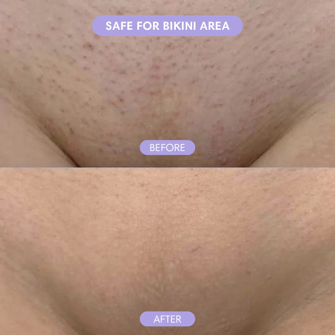 Epilator | Schmerzfreie Haarentfernung | Für Gesicht, Beine & Bikini