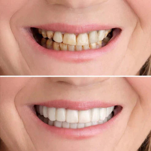 1+1 Gratis | SmileFix™ - Schaffen Sie die perfekten Zähne