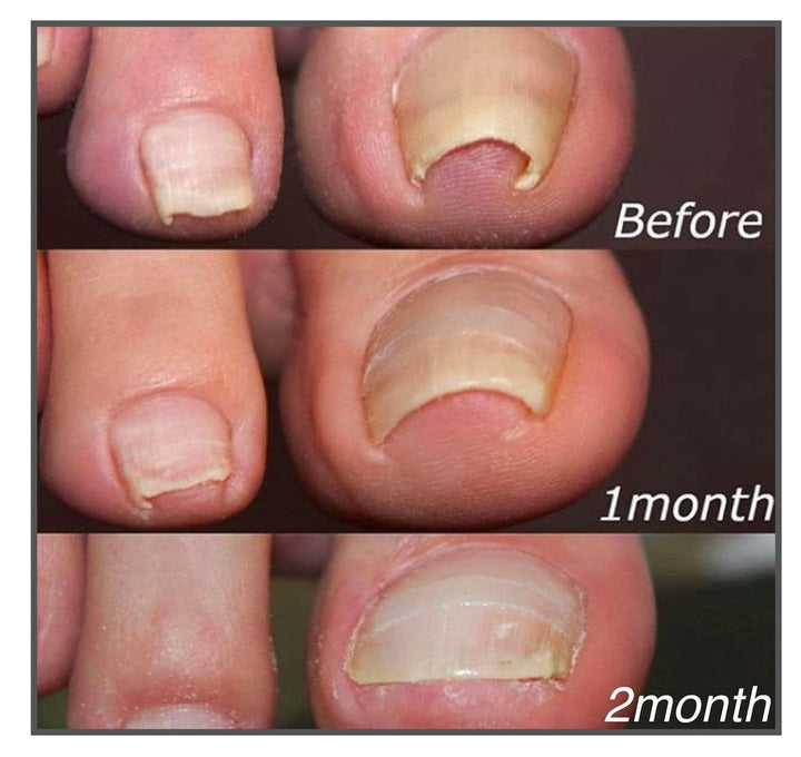 EasyPatch Zehennagelpflaster | Eingewachsene Nägel entfernen | Fördert Nagelregeneration | 1+1 Gratis