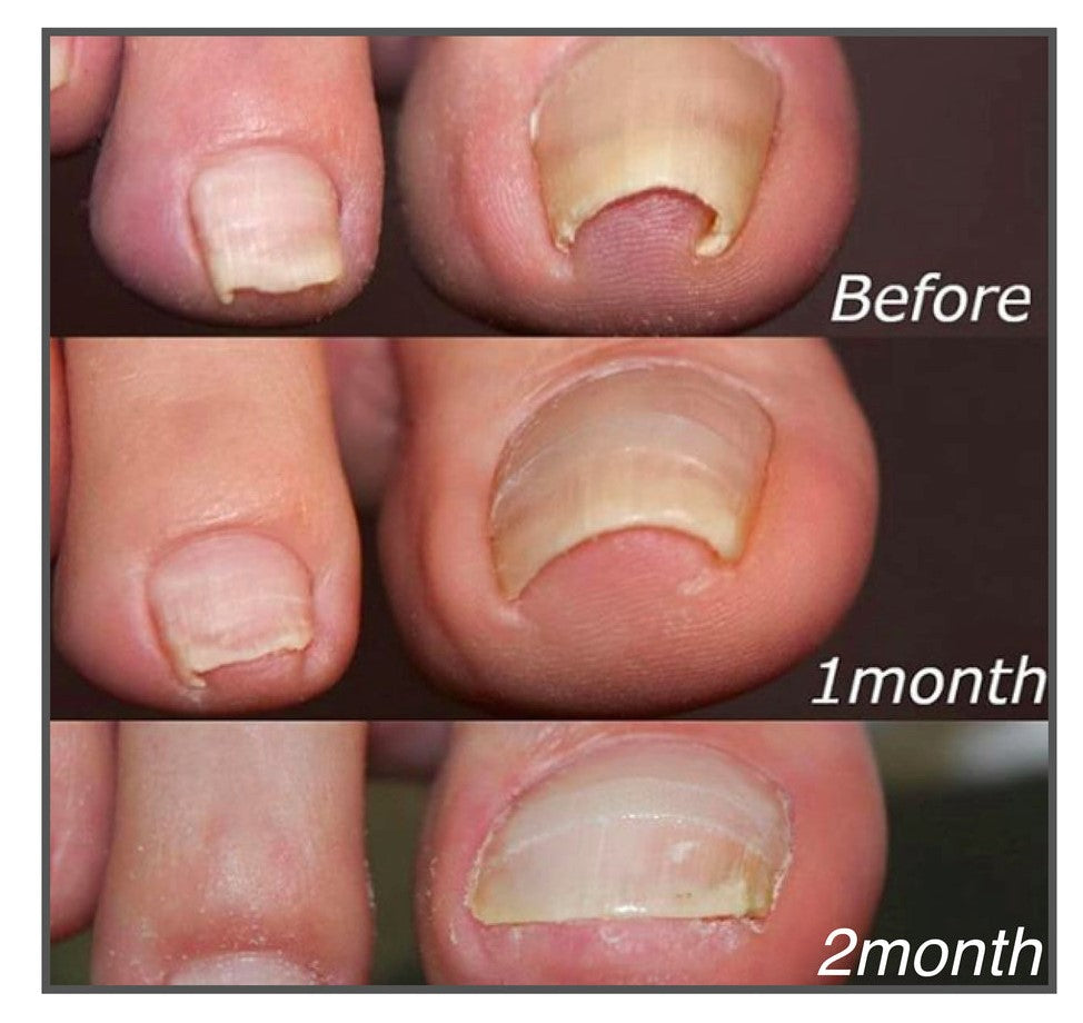 NailFixer™ Nagelkorrekturstreifen | Schmerzlinderung bei Eingewachsenen Nägeln | Dünn & Unauffällig | Medizinisches Pflaster