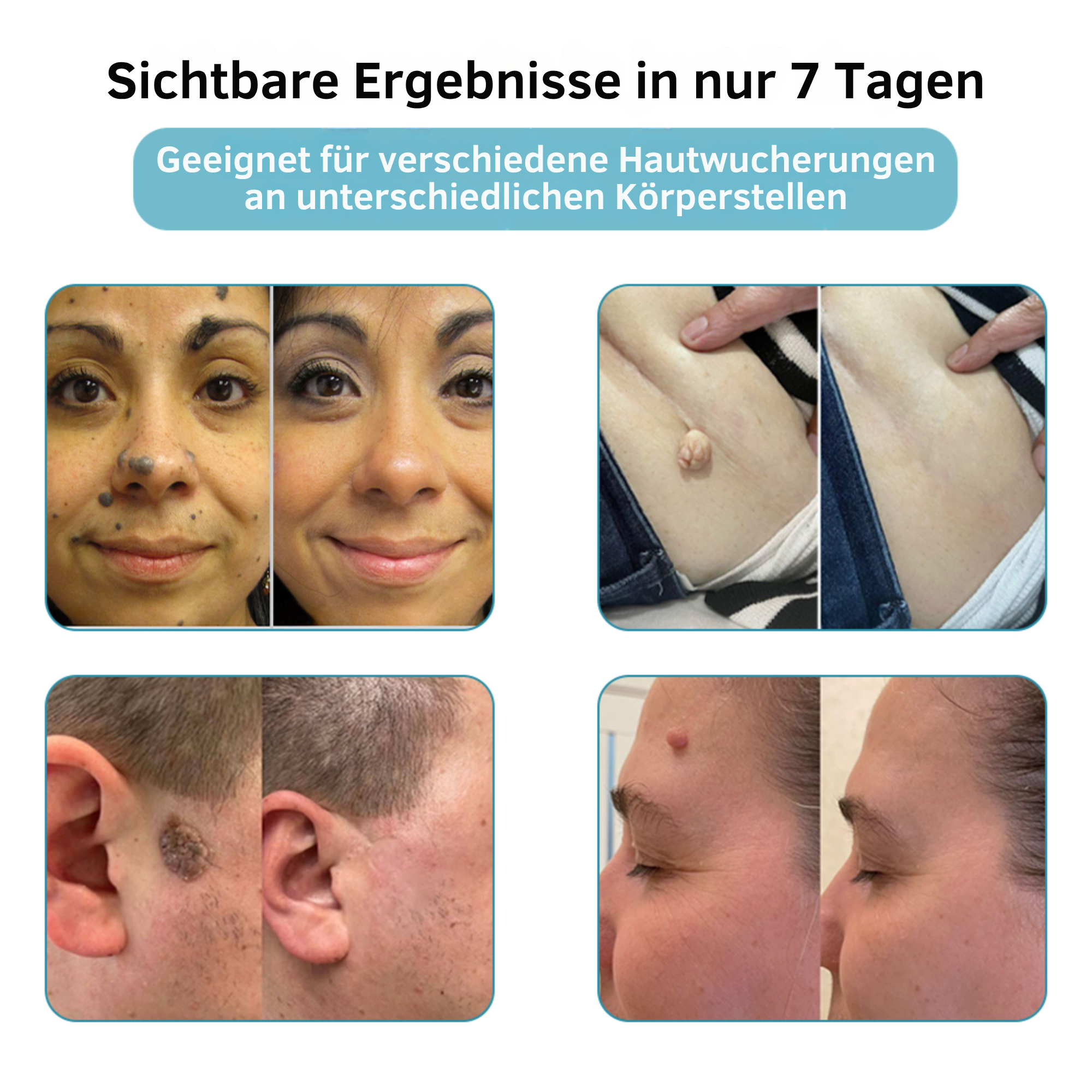 Klara™ Schmerzfreier Laser-Stift — Enthülle jederzeit makellose Haut und Selbstvertrauen