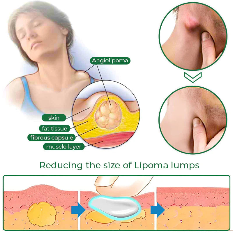 1+1 Gratis | LipomaCure™ - Beruhigende Salbe