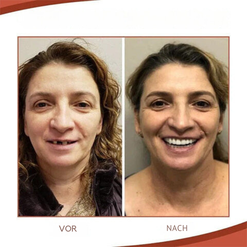 Passgenau & Biokompatibel | Schmerzfreier Sitz | Natürliches Lächeln | ProthesenKumpel Silikon-Set