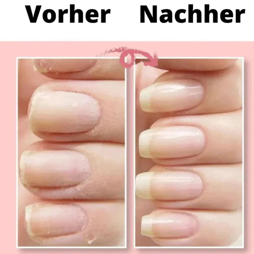 PrettyGel™- Reparieren Sie Ihre Nägel ganz einfach!