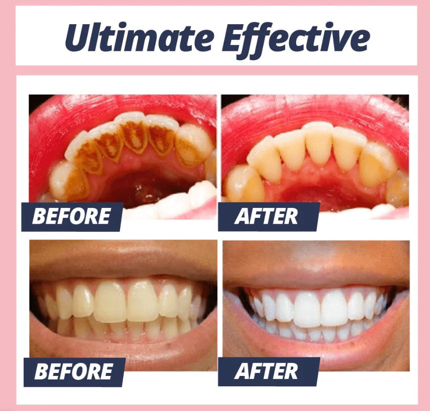 1 + 1 GRATIS HEUTE | CleanStain™- Jeden Tag ein schönes Lächeln haben!