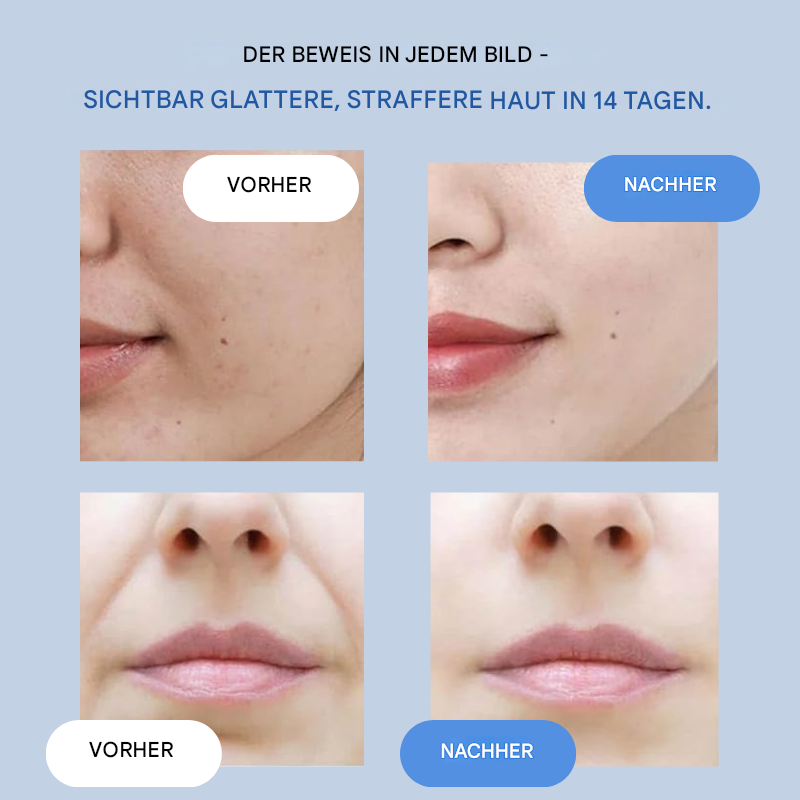 1+1 Gratis | YouthLift Renew Streifen™ Glätten, Straffen und Revitalisieren Sie sofort die natürliche Ausstrahlung Ihrer Haut