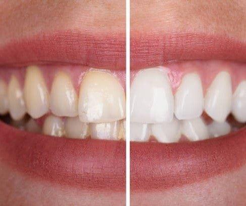 1+1 Gratis | Brightify™ Fühlen Sie sich selbstbewusster mit einem frischen, strahlenden Lächeln, das anhält