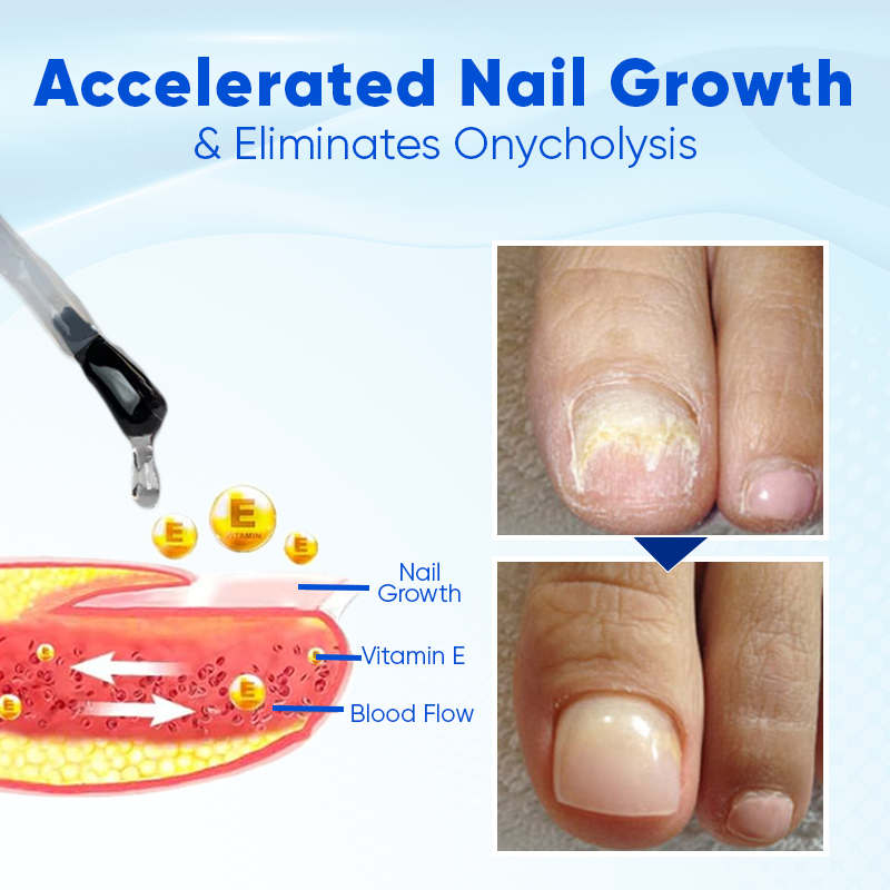 1+1 GRATIS | Biancat™ OnyxoGuard Nagelwachstums- und Reparaturserum — Belebt und stärkt Nägel schnell für gesündere, schönere Nägel