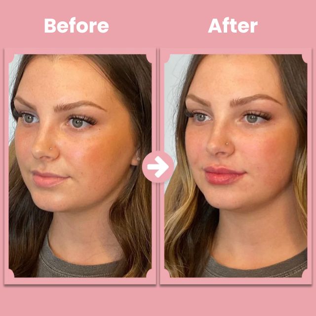 VoluFleur™ Lippenroller – Natürliche volle Lippen, die selbstbewusst strahlen, ganz ohne Schmerzen