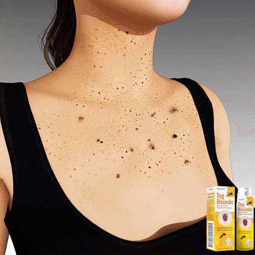 1+1 GRATIS | Warzen- und Maulwurfspray™, Lieben Sie Ihre Haut wieder