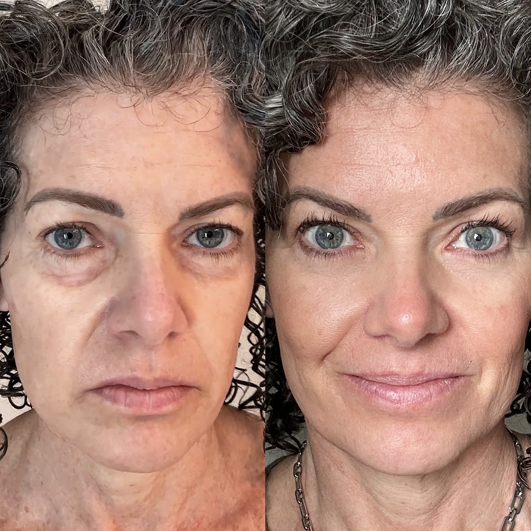 EyeRevive™ | Verabschieden Sie sich von Augenringen und Schwellungen!