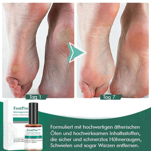 1+1 Gratis | FootPro™ Maisentfernungsgel