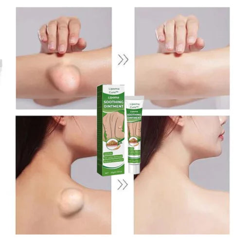 LipomaCure Salbe | Gegen Lipome & Schwellungen | Pflanzlich & Tiefenwirksam | 1+1 Gratis