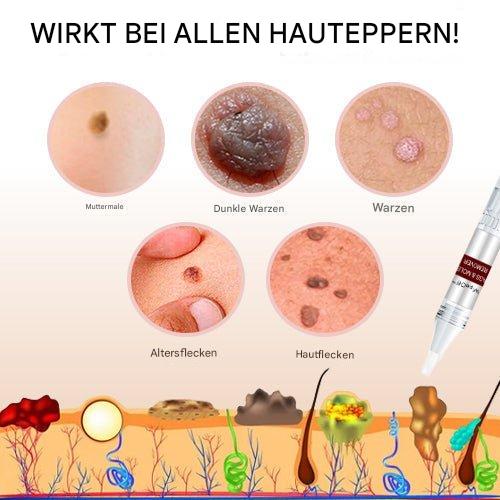 1+1 Gratis | WartOff™ Einfache Entfernung Von Hautflecken Und Muttermalen