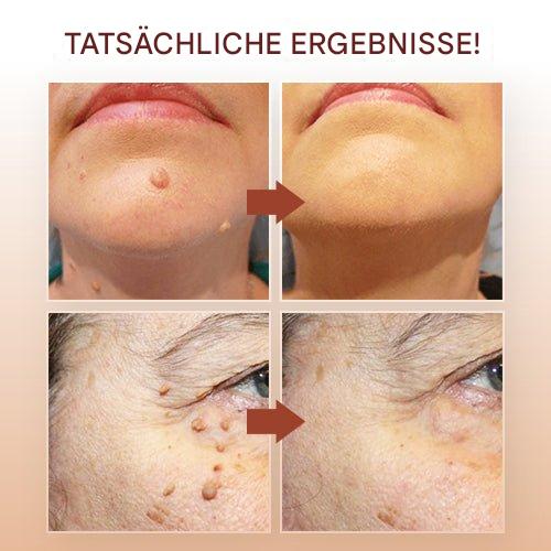 1+1 Gratis | WartOff™ Einfache Entfernung Von Hautflecken Und Muttermalen