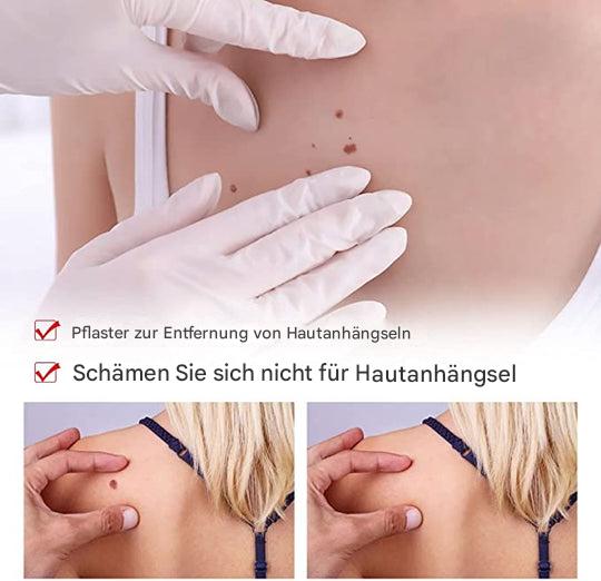 1+1 Gratis | WartOff™ Einfache Entfernung Von Hautflecken Und Muttermalen