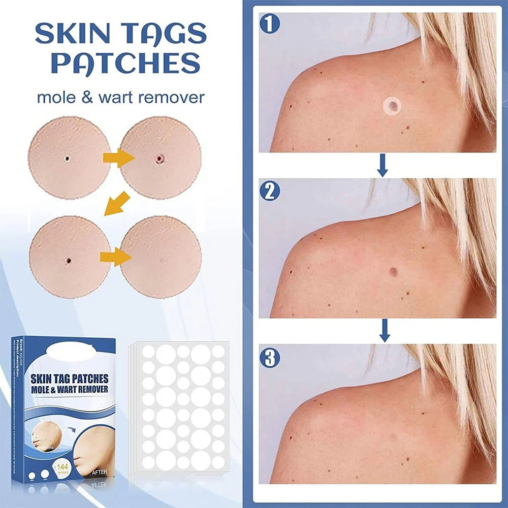TagAway™ - Schmerzfreie, nicht-invasive Behandlung
