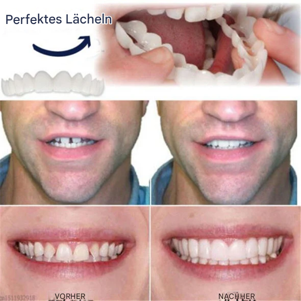 1+1 Gratis | SnapSmiles™ Erreichen Sie einfach und kostengünstig das perfekte Lächeln