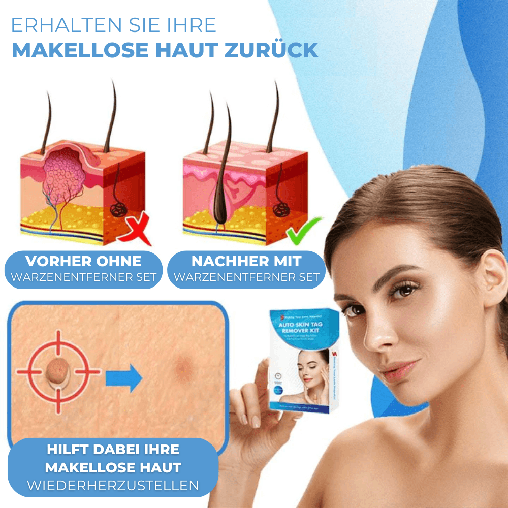Warzen & Muttermale Entferner Set