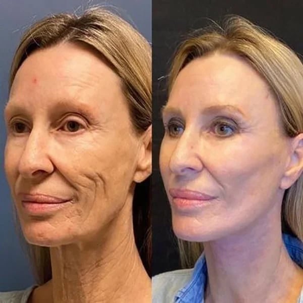 1+1 GRATIS | Hyalu™ - Botox Gesichtsserum